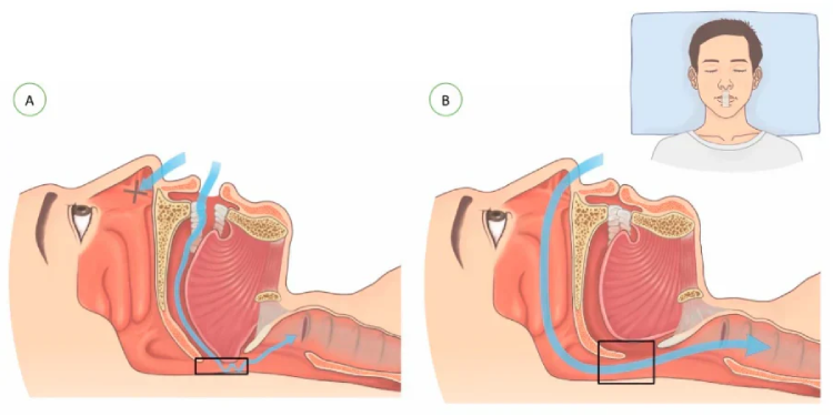 Tackling Mild Obstructive Sleep Apnea with Mouth Taping